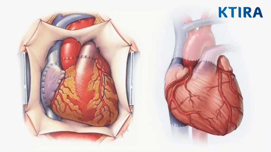 Bệnh tim bẩm sinh ở người lớn
