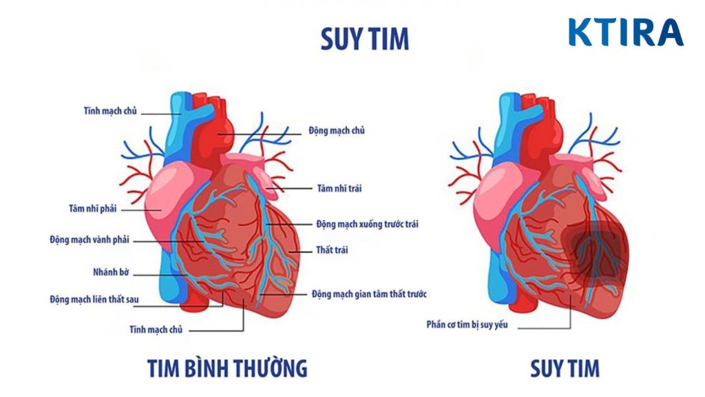 Triệu chứng nặng