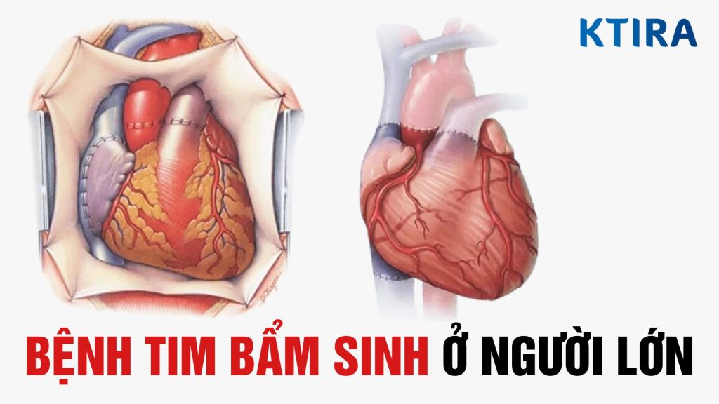 Bệnh tim bẩm sinh ở người lớn