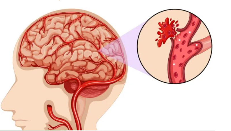 Dự phòng đột quỵ tại nhà