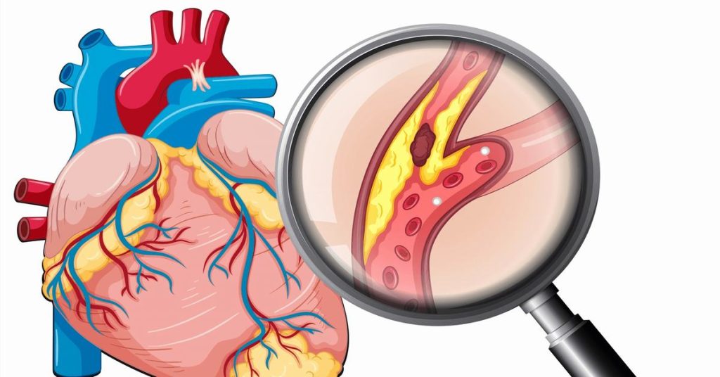 Nguyên nhân gây bệnh tim mạch vành KTIRA