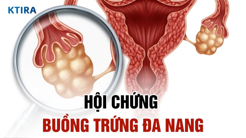 Hội chứng buồng trứng đa nang và 3 cách quản lý hiệu quả