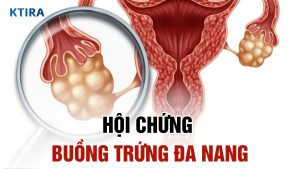 Hội chứng buồng trứng đa nang và 3 cách quản lý hiệu quả