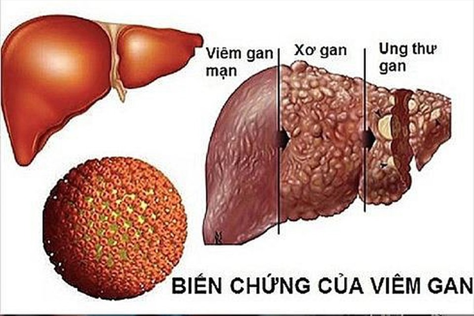 Gan khỏe mạnh và Gan bị Viêm