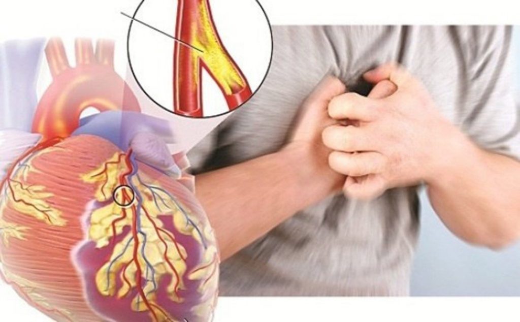 Bệnh động mạch vành là gì?