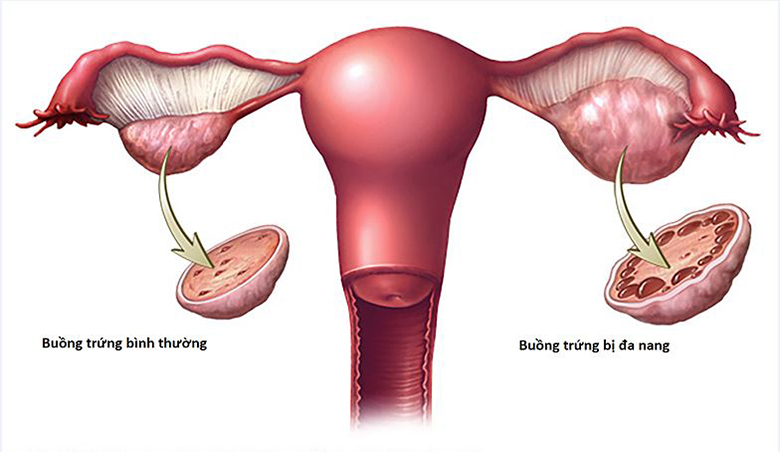 Hội chứng buồng trứng đa nang và 3 cách quản lý hiệu quả