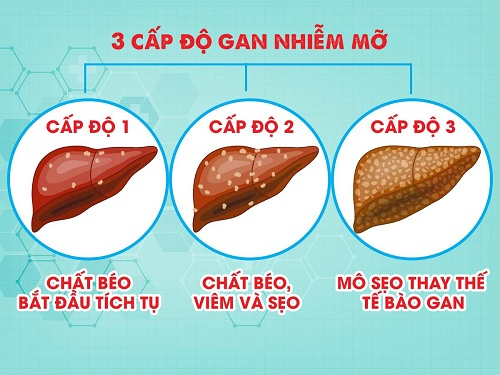 Gan nhiễm mỡ độ 1 và các độ khác