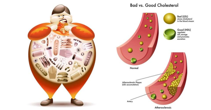 Rối loạn chuyển hóa lipid máu