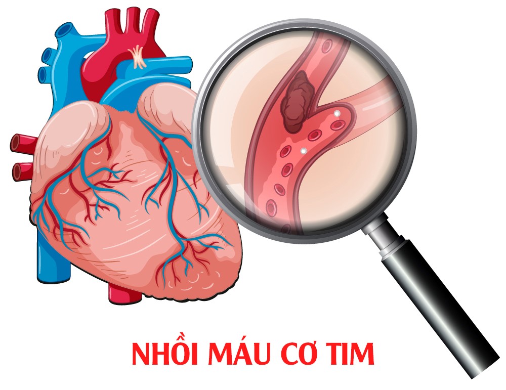 Minh họa bệnh nhồi máu cơ tim