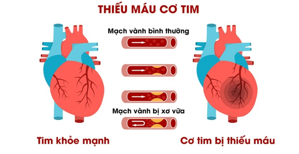 Minh họa hình ảnh Bệnh cơ tim thiếu máu