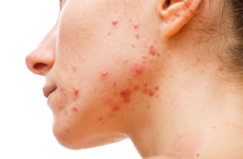 Nguyên nhân rối loạn nội tiết gây mụn