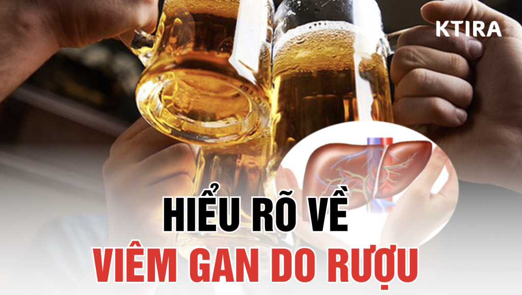 hiểu rõ về viêm gan do rượu KTIRA