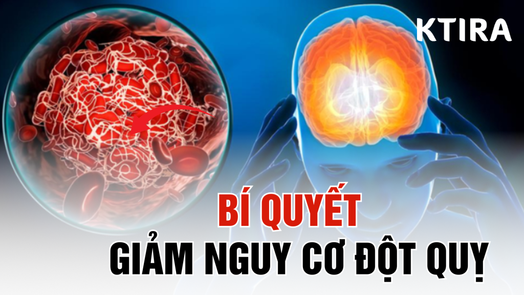 Giảm nguy cơ đột quỵ với 6 bí quyết đơn giản