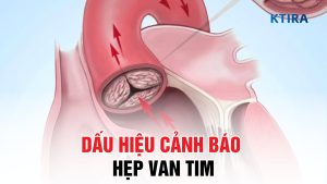 Nhận biết 6 dấu hiệu hẹp van tim