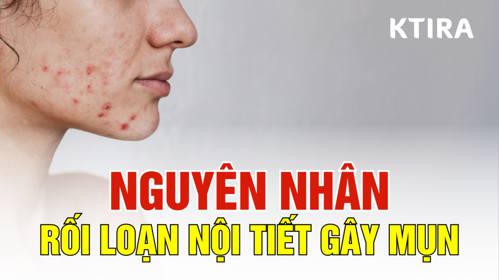 Nguyên nhân rối loạn nội tiết gây mụn