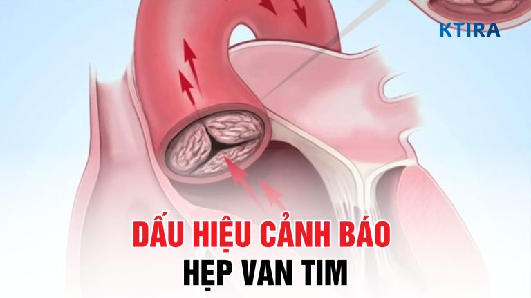 6 Dấu Hiệu Hẹp Van Tim Bạn Không Thể Bỏ Qua – Cảnh Báo Sức Khỏe Đáng Lo!