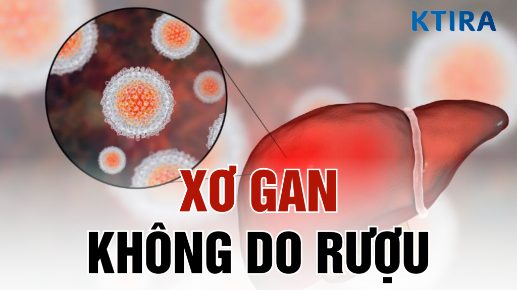 Xơ gan không do rượu