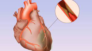 Bệnh tim thiếu máu cục bộ là gì ?
