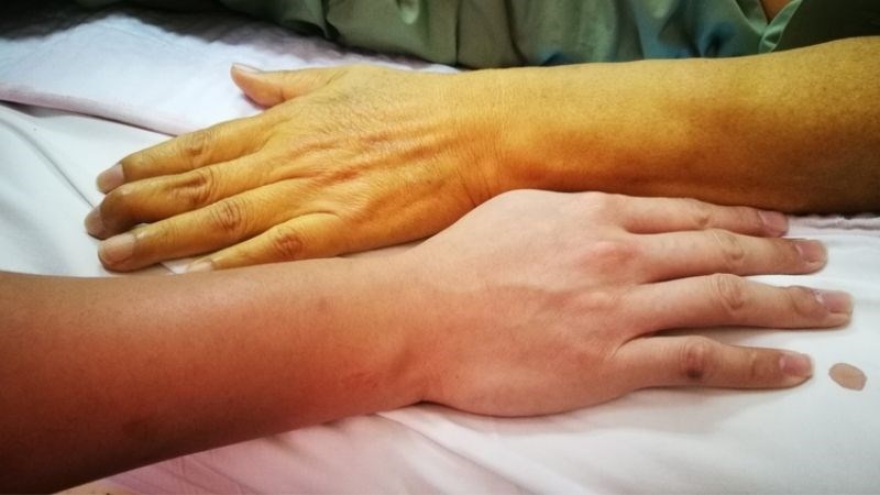 Nhận biết dấu hiệu viêm gan cấp