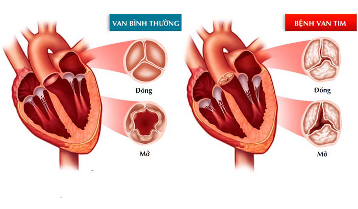 Bệnh van tim hai lá là gì?