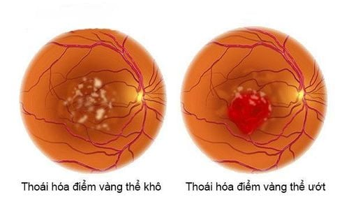 Thoái Hóa Điểm Vàng Ở Mắt