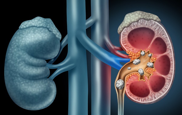 Các loại bệnh thận và 4 cách điều trị