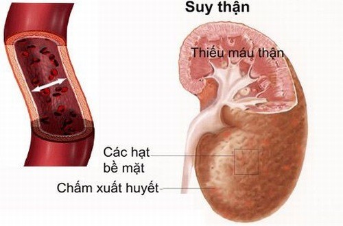 Minh họa hình ảnh suy giảm chức năng thận