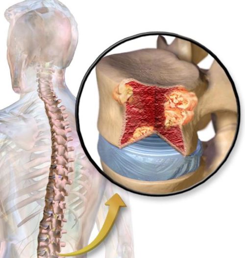 Nguyên nhân thiếu máu do suy tủy xương