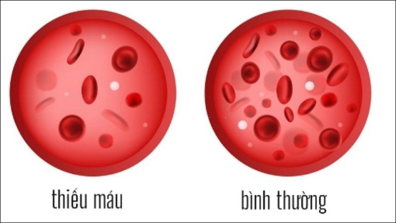 Thiếu Máu Di Truyền là gì KTIRA
