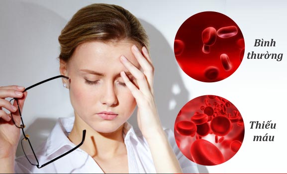 Các triệu chứng của thiếu máu ác tính