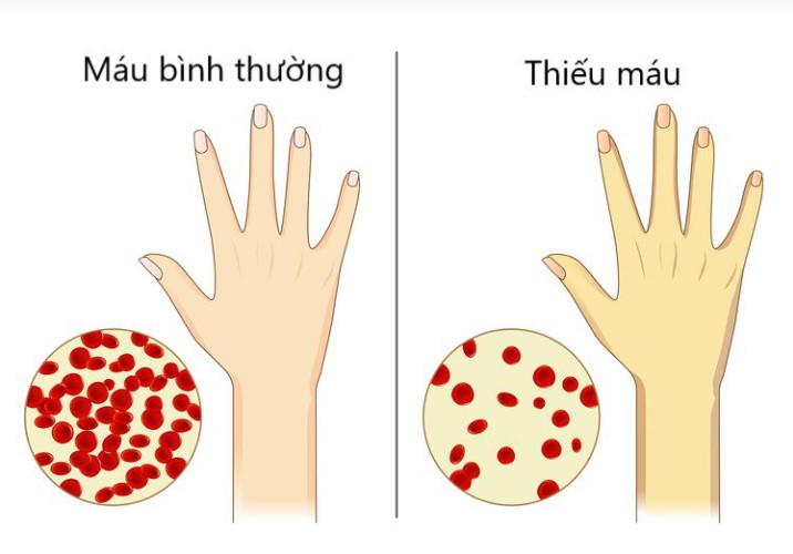 Dấu hiệu thiếu máu ở trẻ em