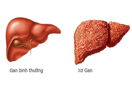 Hiểu về gan nhiễm mỡ độ 3