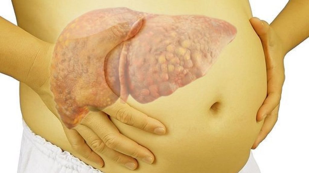 Xơ gan cổ trướng