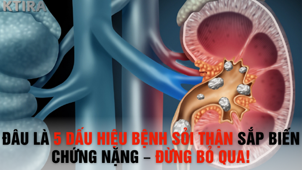Bác Sĩ Cảnh Báo: Đây Là 5 Dấu Hiệu Bệnh Sỏi Thận Sắp Biến Chứng Nặng – Đừng Bỏ Qua!
