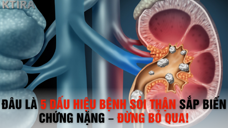 Bác Sĩ Cảnh Báo: Đây Là 5 Dấu Hiệu Bệnh Sỏi Thận Sắp Biến Chứng Nặng – Đừng Bỏ Qua!