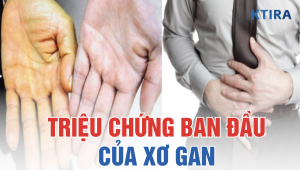 Triệu Chứng Ban Đầu Của Xơ Gan