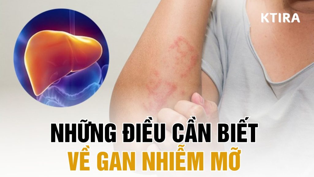 Tìm hiểu về gan nhiễm mỡ
