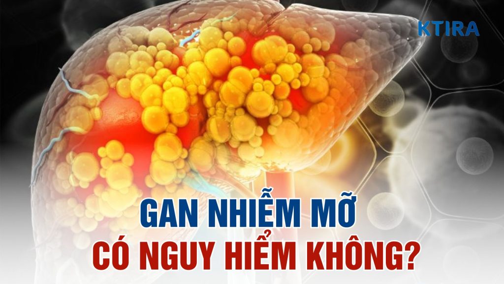 Gan nhiễm mỡ có nguy hiểm không?