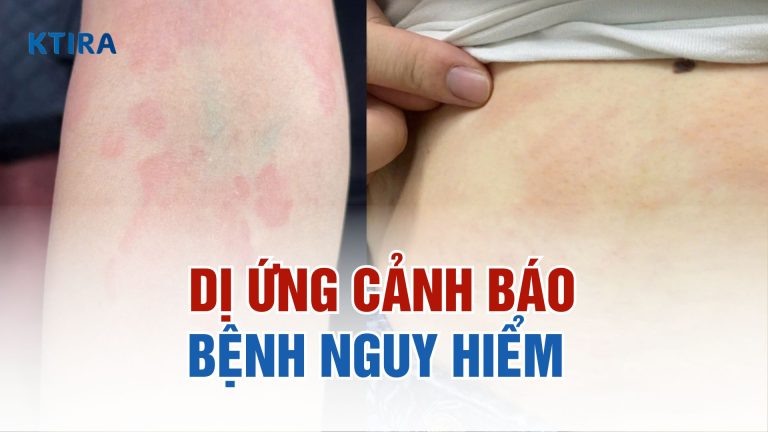 Dị ứng là dấu hiệu cảnh báo 4 bệnh nghiêm trọng cần chú ý!