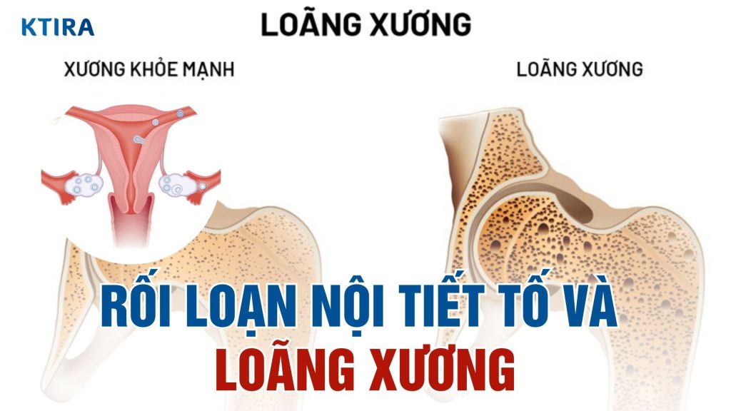 Rối loạn nội tiết tố và loãng xương