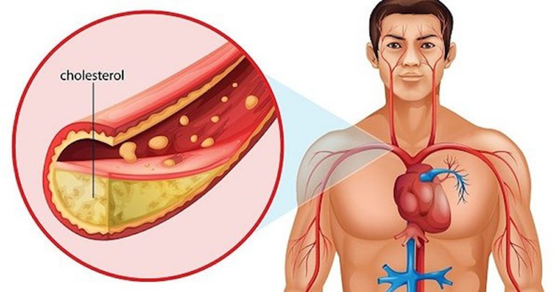 Giảm cholesterol tự nhiên