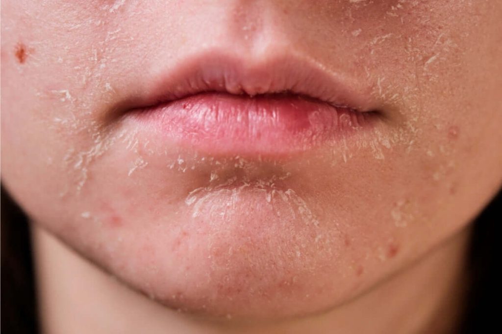 Dấu hiệu lão hóa da sớm