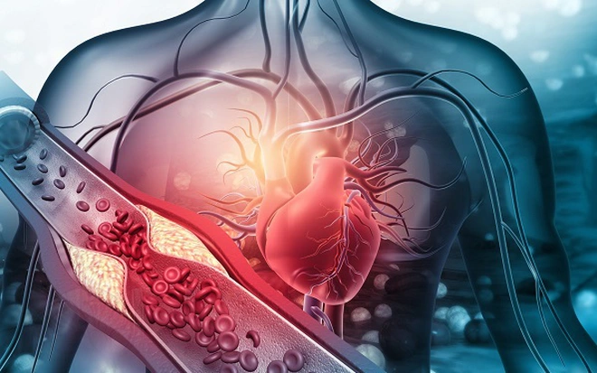 Giảm nguy cơ đột quỵ ở người mỡ máu cao