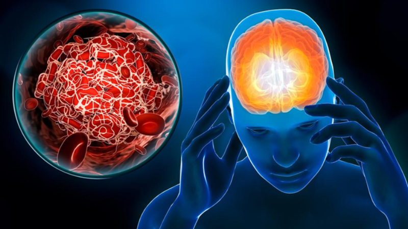Cách nhận biết đột quỵ kịp thời