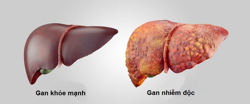 Gan nhiễm độc do thuốc là gì?