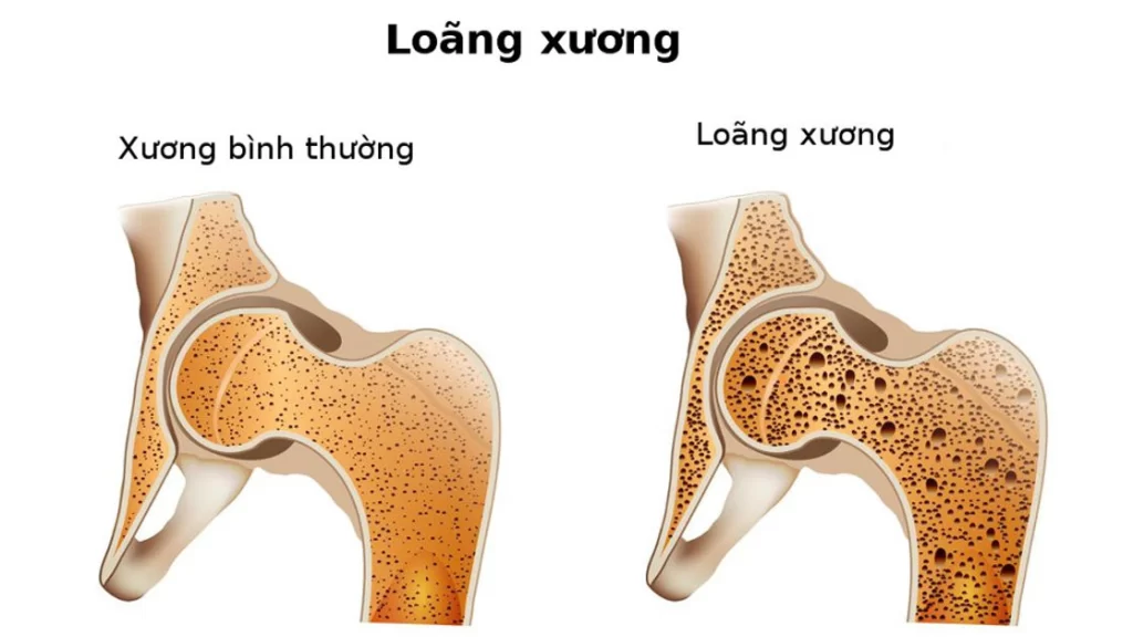 Rối loạn nội tiết tố và loãng xương