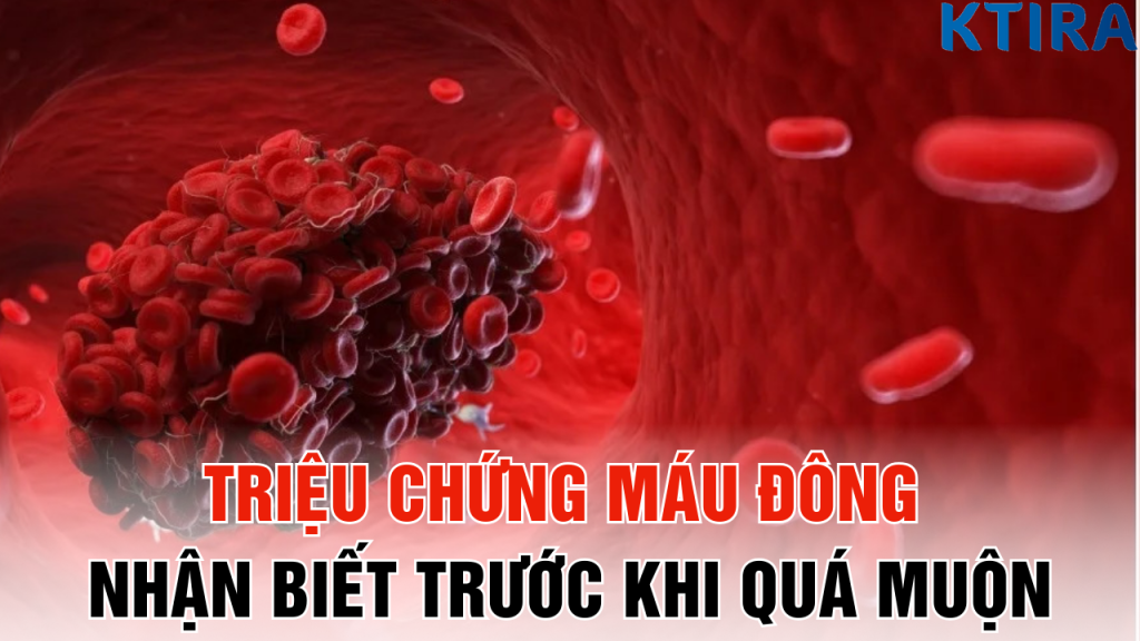 Triệu Chứng Máu Đông nhận biết trước khi quá MUỘN