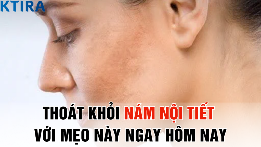 Thoát khỏi nám nội tiết Với mẹo này ngay hôm nay