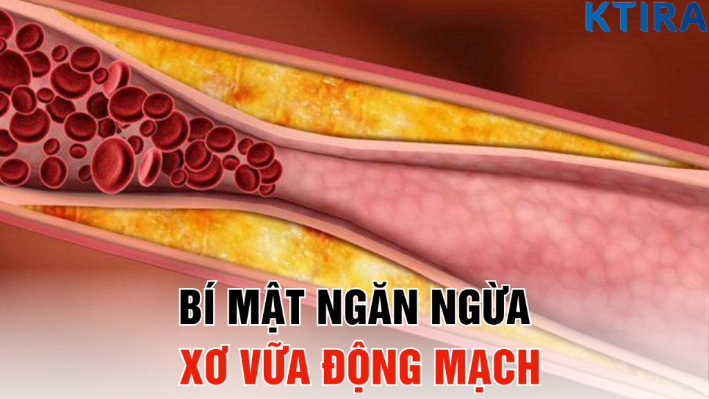 Bí Mật Ngăn Ngừa Xơ Vữa Động Mạch: 99% Người Không Biết Điều Này!