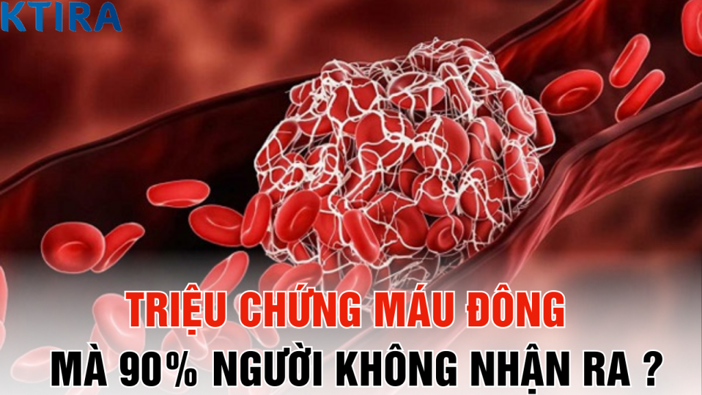 Triệu chứng máu đông xuất hiện mà 90% người không nhận ra – Bạn có nằm trong số đó?
